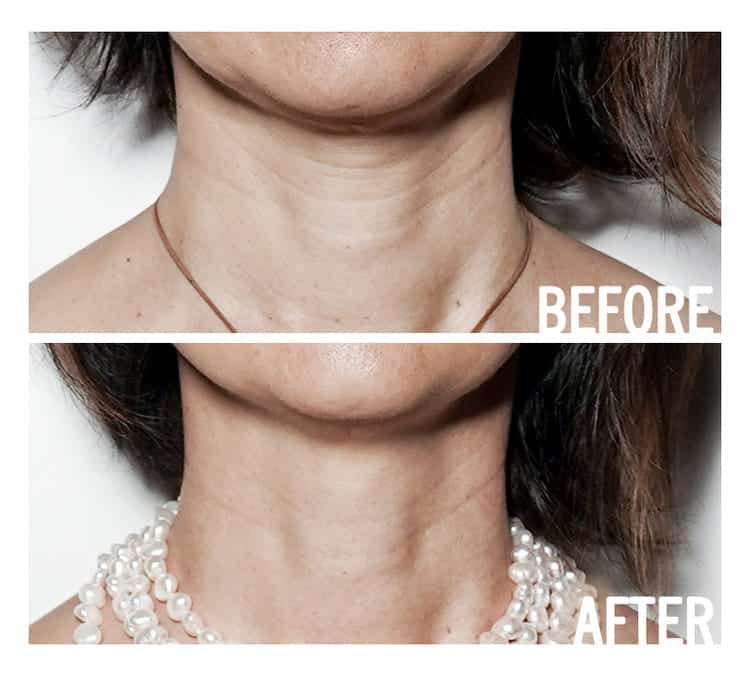 access facelift lifting facial énergétique